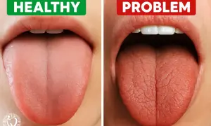 Zdrowy język vs. język z problemem: suchość w jamie ustnej może być skutkiem ubocznym leków.