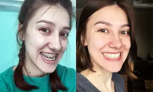 Przed i po leczeniu ortodontycznym. Czy progenia to problem? Zobacz, jak aparat zmienił uśmiech.