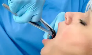 Dentysta w niebieskich rękawiczkach używa kleszczy do ekstrakcji zęba. Pacjentka z otwartymi ustami czeka na moment, kiedy kawa po wyrwaniu zęba będzie już tylko wspomnieniem.