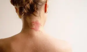 Roter, schuppiger Ausschlag am Nacken, der auf Neurodermitis hindeutet. Suche nach Neurodermitis Hausmittel zur Linderung.