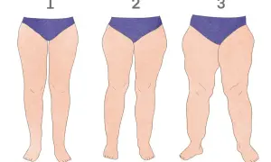 Ilustracja przedstawia trzy pary nóg o różnym stopniu lipodemi: 1 - łagodny, 2 - umiarkowany, 3 - zaawansowany.