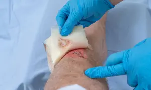 Ein Bein mit einer genähten Wunde und Anzeichen schlechter wundheilung wird mit einem Verband versorgt.