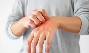 Juckende Hand, die sich kratzt. Ein roter Ausschlag deutet auf eine wunde Stelle hin, für die Hausmittel gesucht werden.
