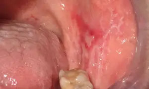 Lesioni biancastre e rosse nella bocca, indicative di lichen planus orale, in attesa di terapia.