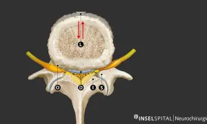 Querschnitt einer Wirbelsäule mit Darstellung der neuroforaminalen Enge. Ein Nerv (gelb) wird durch knöcherne Strukturen und Gewebe eingeengt.