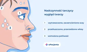 Nadczynność tarczycy: wytrzeszczone oczy (1), przetłuszczone włosy (2), wzmożona potliwość (3).