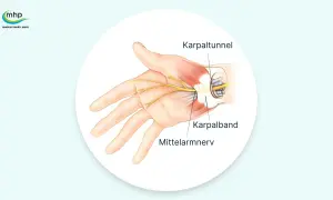 Anatomische Darstellung des Karpaltunnels, der den Mittelarmnerv und das Karpalband zeigt. Mögliche Ursachen für Karpaltunnelsyndrom Symptome.
