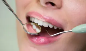 Usta kobiety z białymi zębami, badane lusterkiem dentystycznym. Na dziąśle widoczna jest mała, biała kulka.
