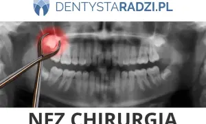 Chirurgia stomatologiczna NFZ: Co pokrywa Fundusz? Pełny przewodnik