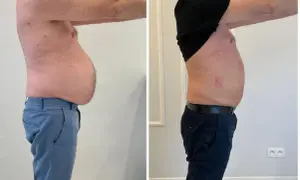 Liposukcja: Modelowanie sylwetki metody, efekty, ryzyko, ceny