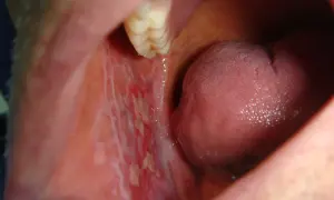 Lesioni biancastre e arrossate all'interno della bocca, possibili sintomi di lichen planus da stress.