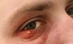 Widoczny wylew na powiece, zaczerwienienie i obrzęk wokół oka.