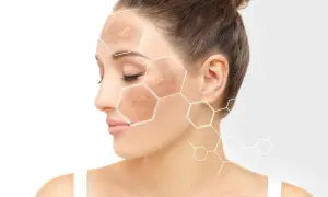 Mujer con manchas en la cara, destacadas con un patrón hexagonal.