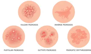 Ilustracja przedstawia różne rodzaje łuszczycy: plackowatą, odwróconą, krostkową, kropelkowatą i erytrodermię łuszczycową.