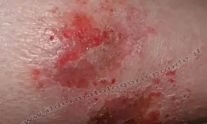 Macchie infiammate e screpolate sulle gambe, con aree arrossate e desquamazione.