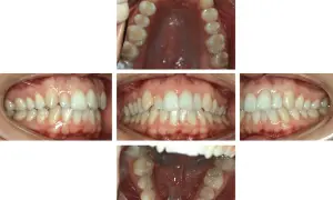 Denti con malocclusione 2 classe, in attesa di trattamento Invisalign.