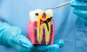 Model zęba pokazuje, ile kanałów ma ząb 2 górna. Widać próchnicę i narzędzie dentystyczne.
