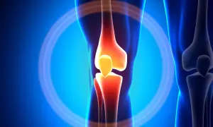 Schmerzendes Knie mit entzündeten Knochen, ein Symbol für die "unhappy triad" des Knies.
