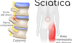 Illustrazione della colonna vertebrale con ernia del disco che comprime un nervo, causando dolore all'area interessata. La durata della sciatica varia.