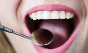 Usta z różową szminką, białe zęby i lusterko dentystyczne. Czy to początek leczenia zatrucia zęba na 3 miesiące?