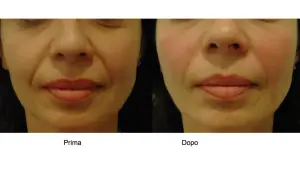 Prima e dopo: il contorno labbra è più definito e le rughe naso-labiali meno evidenti, dimostrando che l'acido ialuronico per bocca funziona.