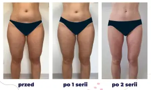 Przed i po kriolipolizie: widoczne efekty wyszczuplenia ud po 1 i 2 seriach zabiegu.