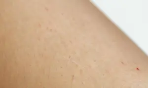 Skóra z drobnymi czerwonymi kropkami i nierównościami, charakterystycznymi dla rogowacenia mieszkowego (keratosis pilaris).