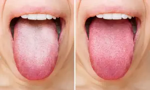 Lingua bianca e patinata prima, rosa e sana dopo. Scopri come pulire la lingua senza vomitare per un alito fresco.