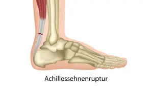 Achillessehnenruptur: Ein Riss in der Achillessehne, der durch Magnesiummangel begünstigt werden kann.