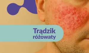 Skóra mężczyzny z widocznym trądzikiem różowatym na policzku. Czerwone, zapalne zmiany skórne.