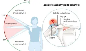 Ilustracja przedstawia zakres ruchu ramienia z zaznaczonym bólem oraz przekrój stawu barkowego z zaznaczonymi strukturami.