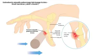 Ilustracja anatomiczna kciuka z zaznaczonym zerwanym więzadłem pobocznym łokciowym.