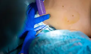 Lekarz w niebieskich rękawiczkach wykonuje biopsję skóry. Widać narzędzie medyczne i zaznaczony obszar na ciele pacjenta.