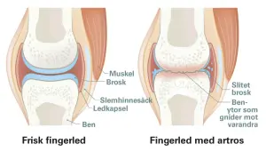 Jämförelse av frisk fingerled och fingerled med artros. Artros visar slitet brosk och benytor som gnider mot varandra, vilket kan förklaras med att osteofyter betyder benpålagringar.