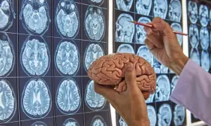 Chirurg neurolog analizuje przekroje mózgu na obrazach MRI, trzymając model ludzkiego mózgu.