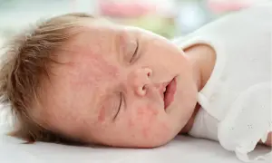 Alergia na mleko modyfikowane objawy – jak je rozpoznać i unikać?