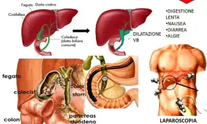 Illustrazione della sindrome post-colecistectomia, con diagrammi del fegato, cistifellea e vie biliari, e immagini di chirurgia laparoscopica. Vivere senza cistifellea può comportare disturbi digestivi.