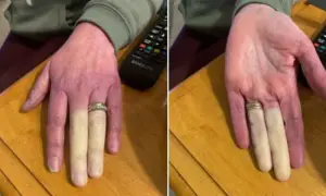 Zimne palce? Objawy Raynauda, czerwone flagi i diagnoza