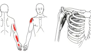 Schmerzpunkte am Arm und Schulterbereich, die auf den m coracobrachialis hinweisen. Detailansicht des Schultergelenks mit Muskeln und Rippen.