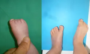 Pied d'enfant présentant une syndactylie de l'orteil, où les orteils sont fusionnés.