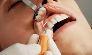 Zabieg stomatologiczny: czy po usuwaniu kamienia można jeść? Dentysta bada zęby pacjenta lusterkiem i narzędziem.