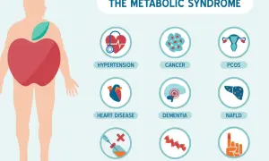 Ilustracja przedstawia zespół metaboliczny i jego powiązane schorzenia: nadciśnienie, choroby serca, insulinooporność, raka, demencję, problemy z lipidami, PCOS i cukrzycę typu 2.