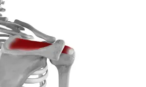 Schulteranatomie: Rot hervorgehobene Supraspinatussehne. Bei einem Riss der Supraspinatussehne was tun?