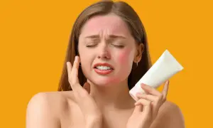 Donna con viso arrossato dal sole, che tiene in mano un tubetto di crema, cercando rimedi casalinghi per scottature da sole.