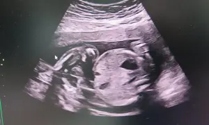 Ultraljud vecka 19 visar ett sovande barn. Ansiktet är tydligt, med en liten näsa och mun. Barnet har armarna uppdragna mot huvudet.