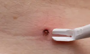 Co jeśli zostanie kawałek kleszcza? Poradnik i ryzyko