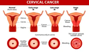 Ilustracja pokazuje rozwój raka szyjki macicy od stadium normalnego do zaawansowanego, z widocznymi zmianami tkankowymi i krwawieniem.