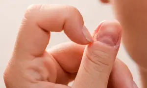 Miękkie paznokcie mogą być oznaką chorób. Widoczny paznokieć jest łamliwy, z widocznymi uszkodzeniami i suchą skórką wokół.
