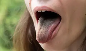 Lingua scura e ruvida, con piccole protuberanze, che suggerisce dolore alla lingua e alla gola.