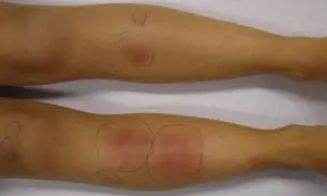 Gambe con segni di pizzichi, arrossamenti e gonfiori evidenziati da cerchi a matita.
